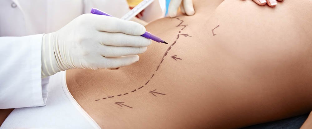        liposuction health procedure woman with lines in the stomach costa rica
  - Costa Rica